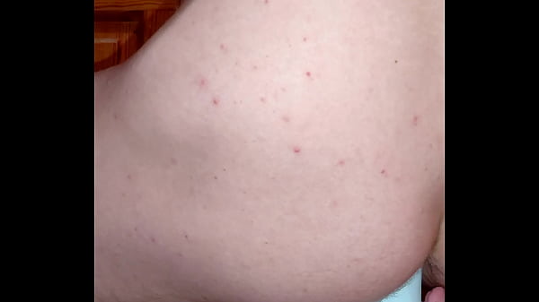 Image My hemorrhoidal prolapse has become very stretched.